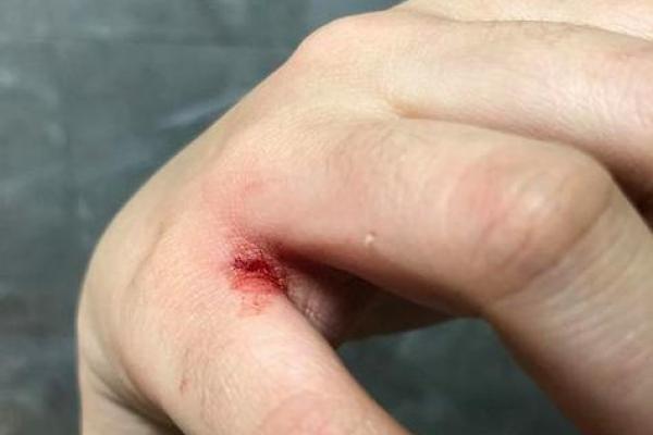 做梦梦到被猫咬了寓意是什么 做梦梦到被猫咬了寓意是什么