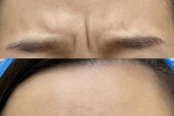 眉间八字纹，眉间两道竖纹代表什么