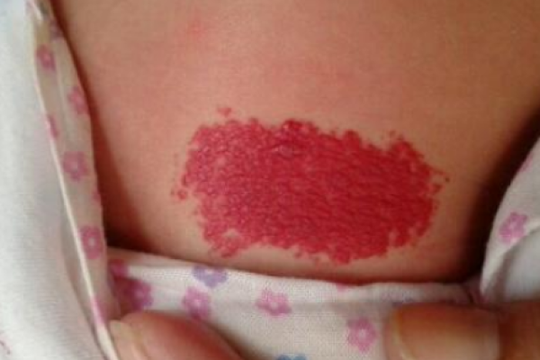 红色的胎记算命