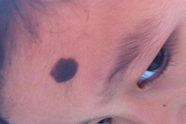 看脸上胎记算命知命运 看脸上胎记算命知命运