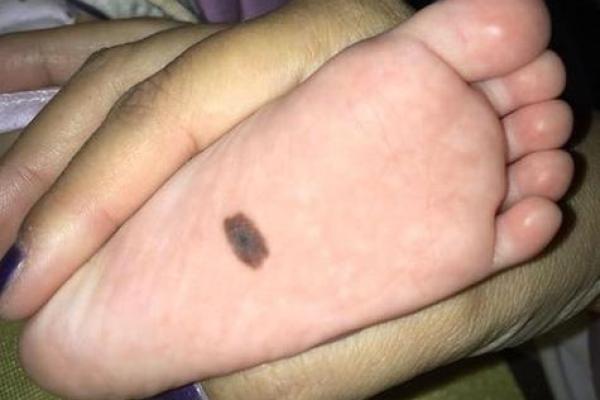 腿上不同位置的胎记算命 腿上不同位置的胎记算命