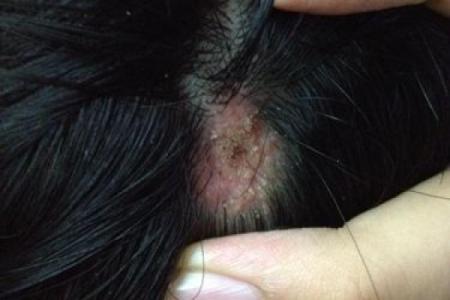 黑色胎记算命分析