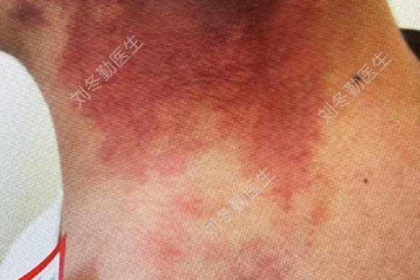 脖子上的胎记如何算命- 脖子上的胎记如何算命-