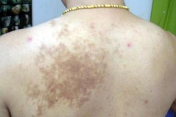 脖子上的胎记如何算命- 脖子上的胎记如何算命-