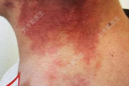 脖子上的胎记如何算命-