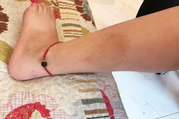 腿上胎记算命分析