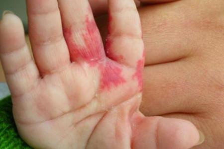 胎记算命：如何看胎记算命