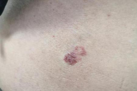 屁股有白斑风水