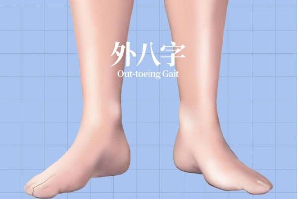 小孩外八字腿 小孩外八字腿