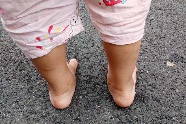 小孩外八字腿 小孩外八字腿