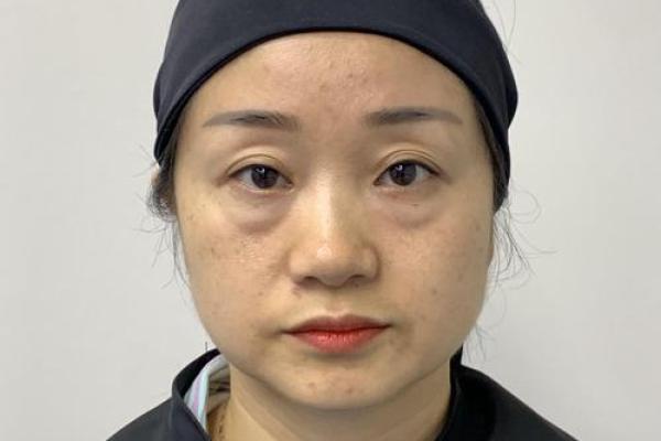 八字眼袋 八字眼袋