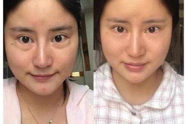 八字眼袋 八字眼袋