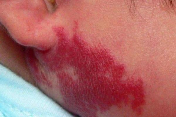 红色胎记算命 红色胎记算命