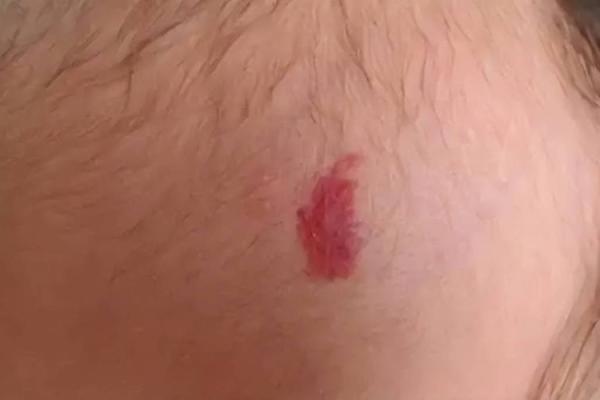 胎记算命:从胎记看运势 胎记算命:从胎记看运势