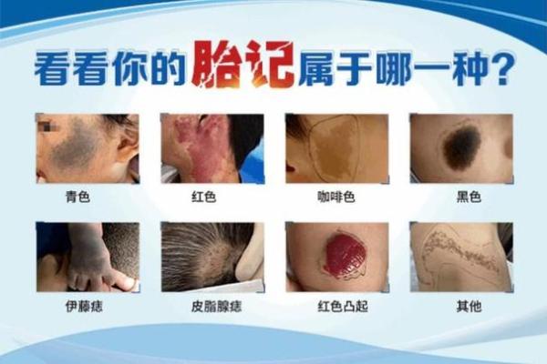 身上胎记算命图解