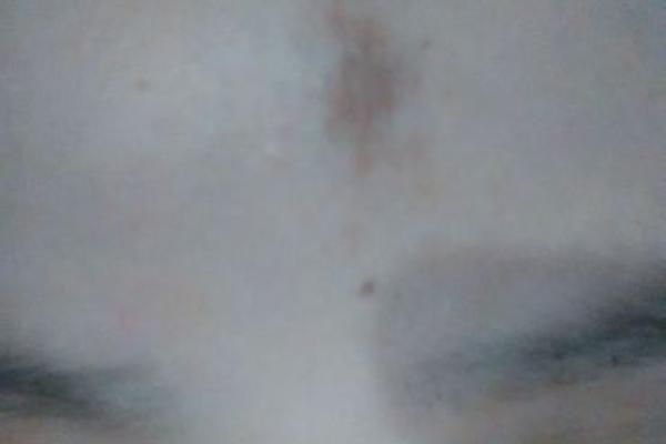 额头长胎记算命一生