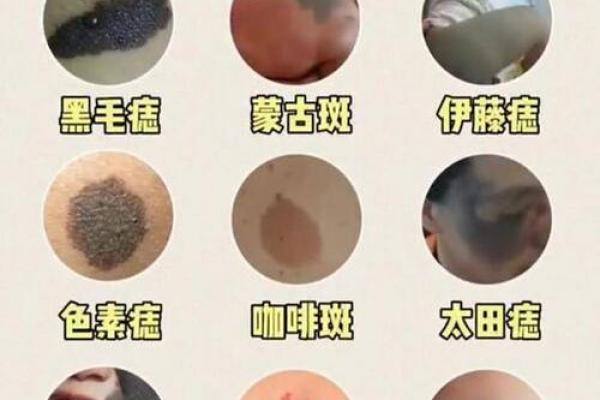 额头长胎记算命一生