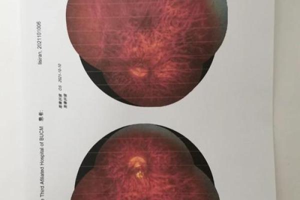 眼睛上的胎记算命分析