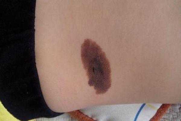 胎记算命:怎么看胎记 胎记算命:怎么看胎记