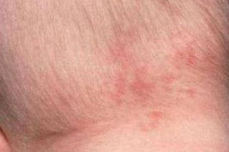 胎记算命：怎么看胎记