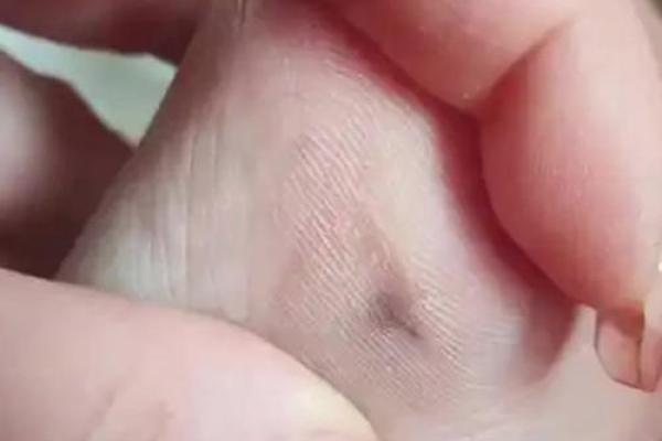 脚上胎记算命,脚底长胎记好不好 脚上胎记算命,脚底长胎记好不好