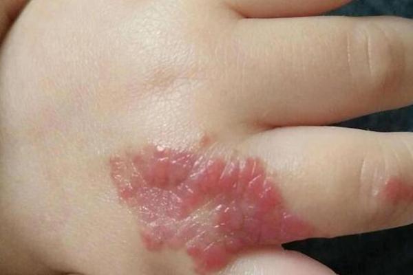 屁股上有胎记算命分析