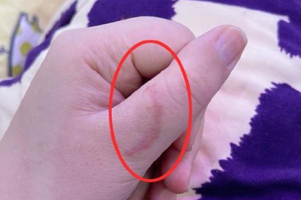 八字看身体伤疤部位的秘诀方法