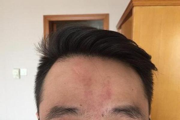 印堂八字纹的男人面相婚姻