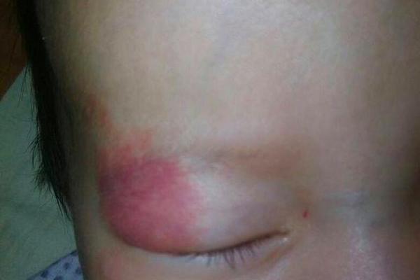 胎记算命图解:什么是红胎记? 胎记算命图解:什么是红胎记?