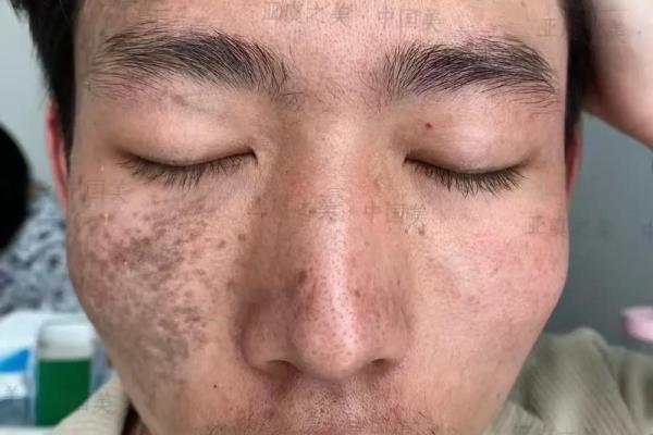 面部上的胎记算命分析