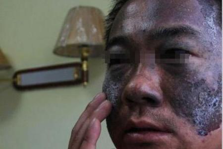 面部上的胎记算命分析