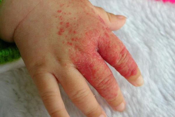 风水胎记胎记是红色的好吗危害