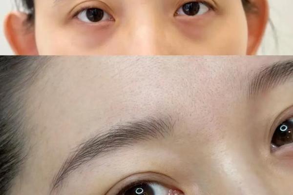 眉间八字纹消除