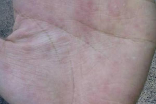 朱砂掌算命，手掌红就是朱砂掌吗？