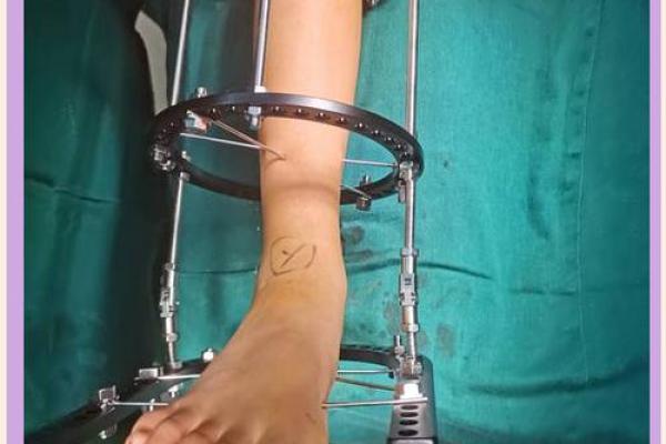 八字腿矫正 八字腿矫正