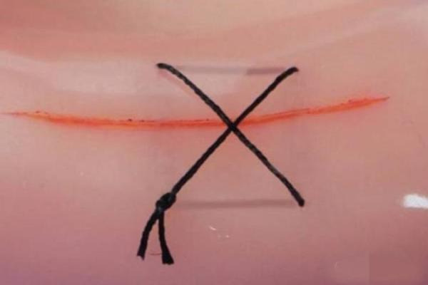 八字缝合 八字缝合