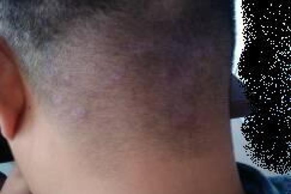 后脑勺有三条竖杠 后脑勺头皮三条竖纹算命