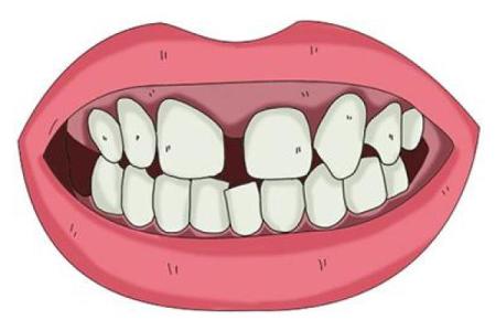 八字型门牙