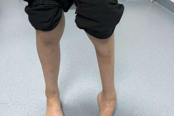 小孩走路内八字 小孩走路内八字