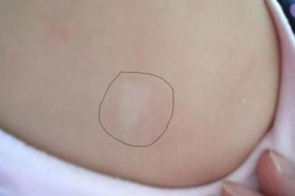 背部胎记算命图解 背部胎记算命图解