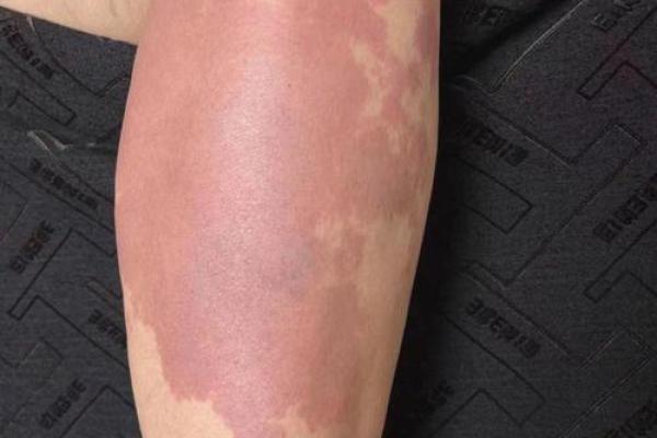 大腿上胎记的位置与算命 大腿上胎记的位置与算命