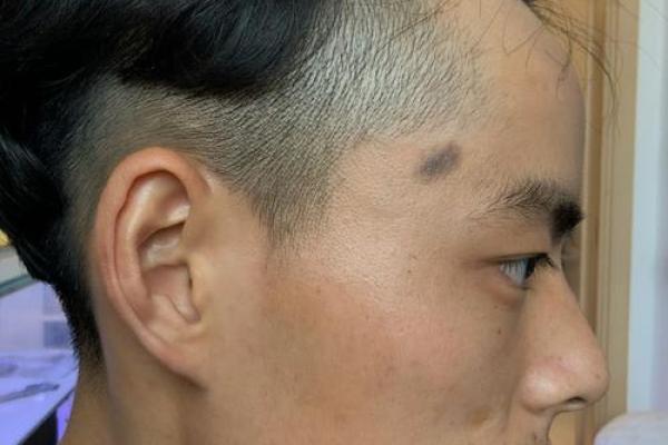 脸的各部位胎记算命详解 脸的各部位胎记算命详解