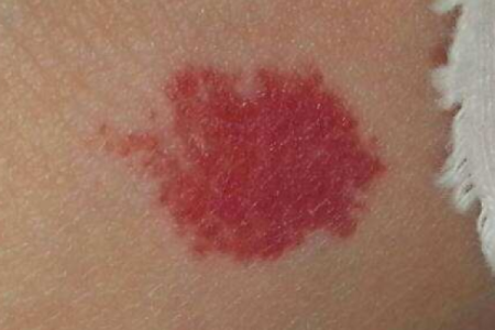 红色胎记算命分析